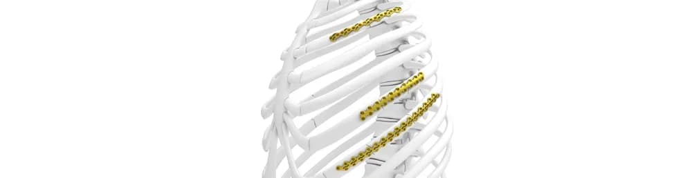 L1® Rib — Travmatologik implant