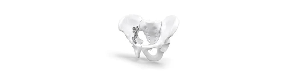 Nexos® Pelvis — Travmatologik implant