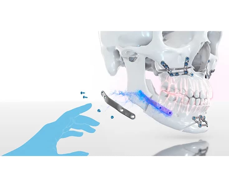 xRS Visualizor — Individual implant yechimi (CMF)