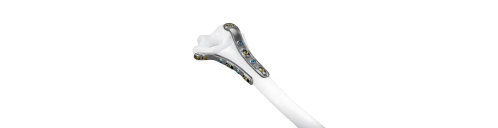 IPS Implants® Distal Humerus Reconstruction — Individual implant yechimi (yuqori oyoq-qo'l)