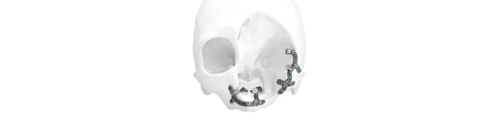 IPS Implants® Epithesis Base — Individual implant yechimi (CMF)