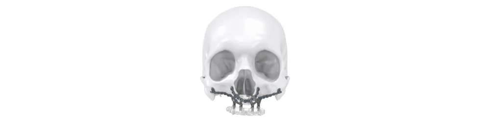 IPS Implants® Preprosthetic — Individual implant yechimi (CMF)